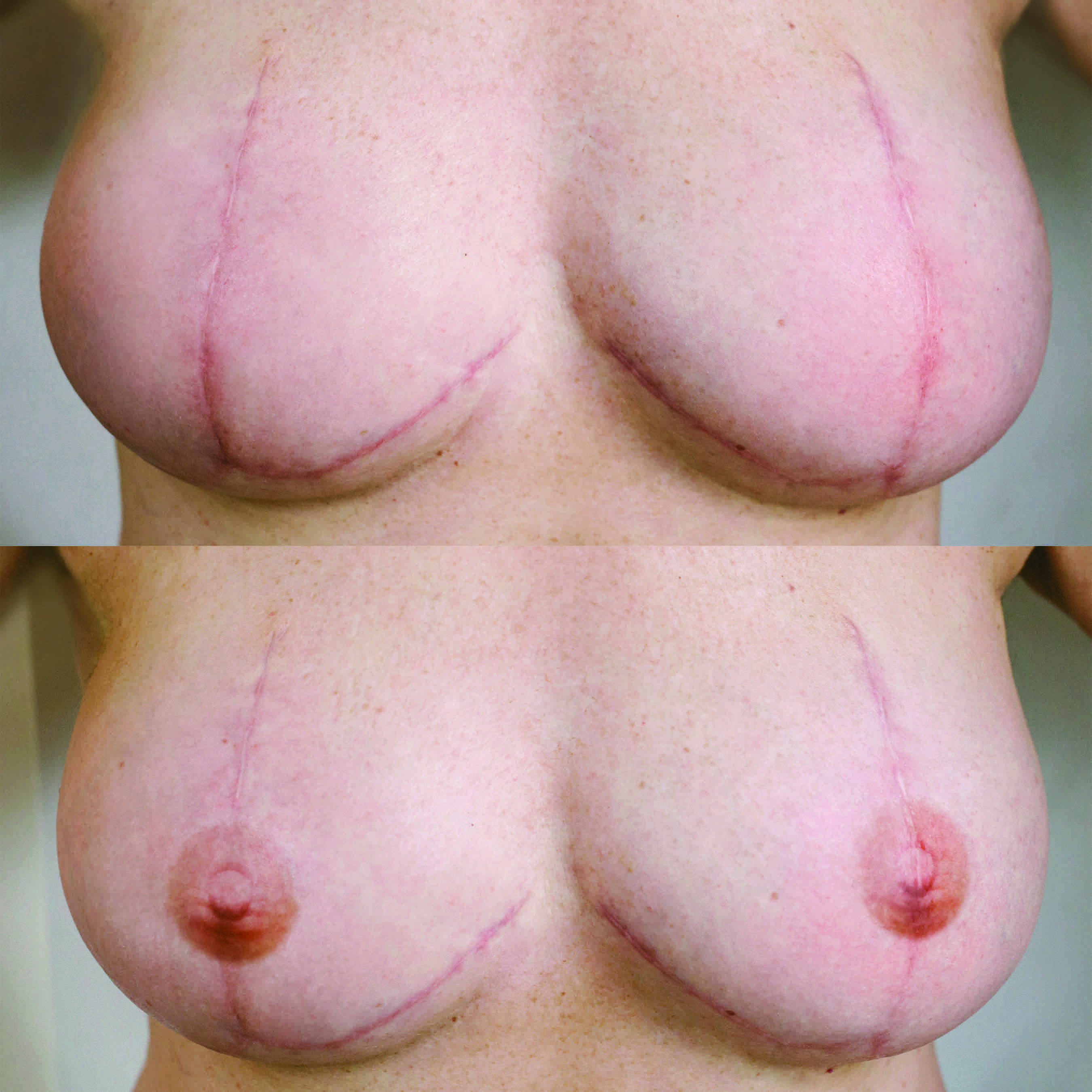Female breasts